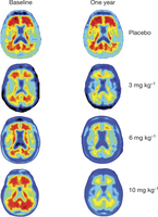 Diminution des plaques amyloides avec aducanamab, TEP, c/o Nature