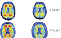 Premier essai prometteur pour un anticorps contre la maladie d'Alzheimer